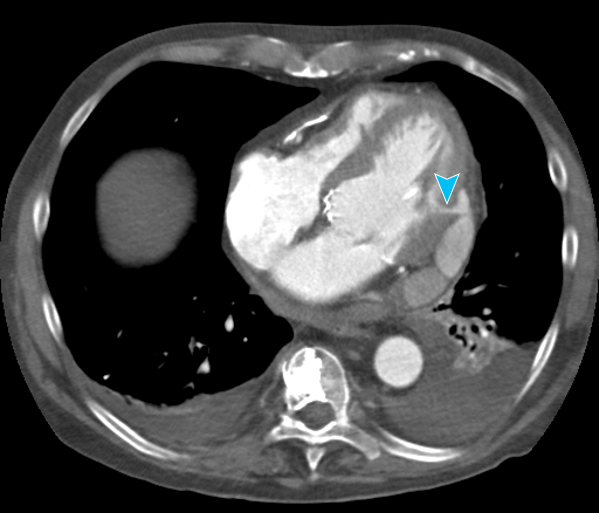 File:Cardiac perforation following transcatheter aortic valve implantation (Radiopaedia 23714-25407 A 1).png