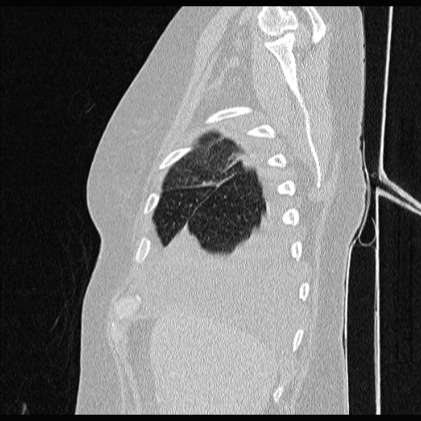 Cardiogenic pulmonary edema (Radiopaedia 29213-29609 Sagittal lung window 14).jpg