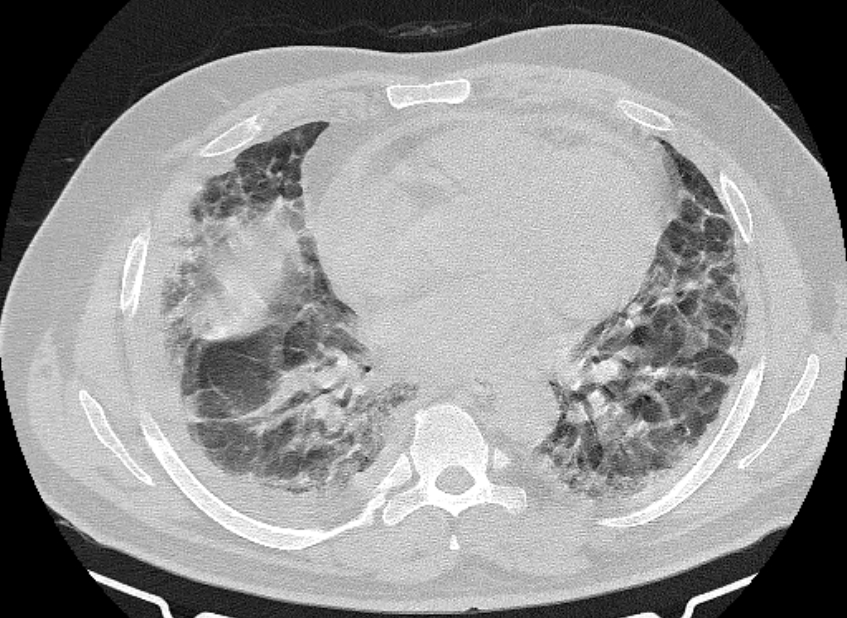Cardiogenic pulmonary edema (Radiopaedia 68180-77678 Axial lung window 59).jpg
