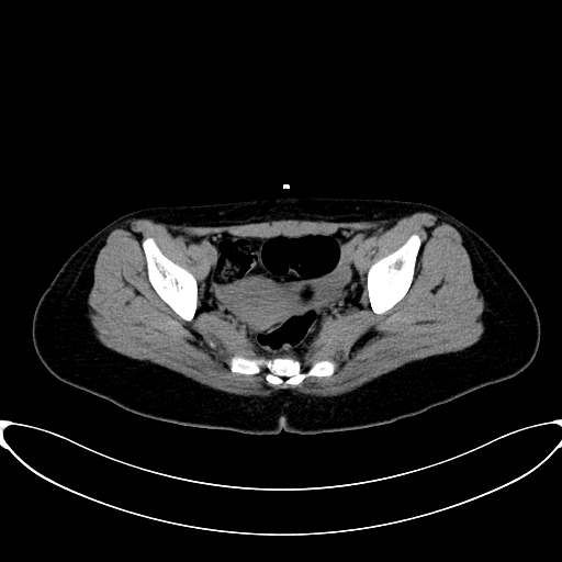 Caroli disease with medullary sponge kidney (Radiopaedia 82622-96804 Axial non-contrast 66).jpg