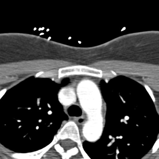 Carotico ophthalmic aneurysm (Radiopaedia 42916-46148 A 107).png