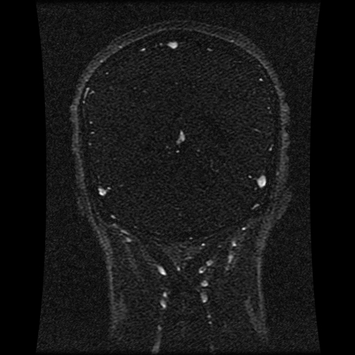 Carotid arterial dissection with acute cerebral infarction (Radiopaedia 26636-26784 MRV 68).jpg