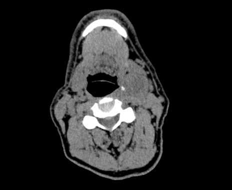 Carotid body tumor (Radiopaedia 61750-69757 Axial non-contrast 48).jpg