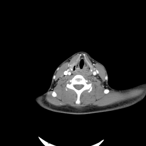 Carotid bulb pseudoaneurysm (Radiopaedia 57670-64616 A 47).jpg