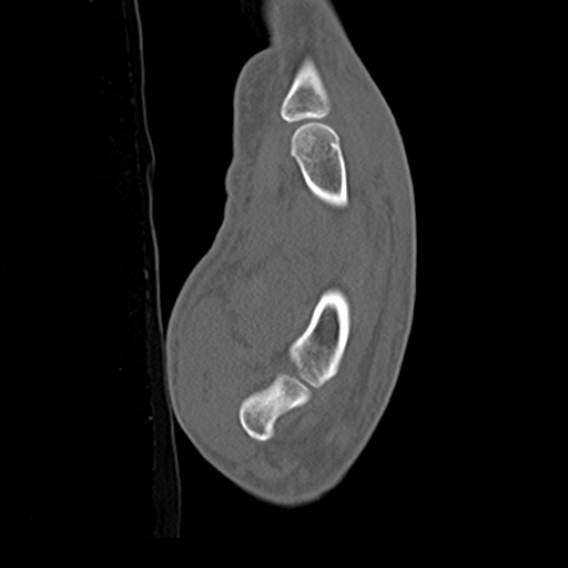 File:Carpo-metacarpal fracture-dislocations with hamatum split fracture (Radiopaedia 18482-18343 Sagittal bone window 25).jpg