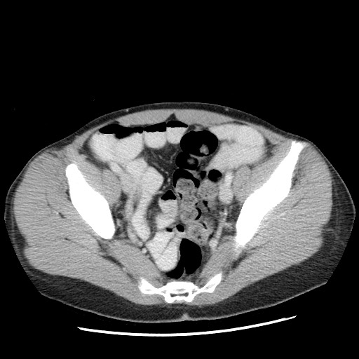 Castleman disease with fibrous pseudotumor in the abdomen (Radiopaedia 77296-89373 A 104).jpg
