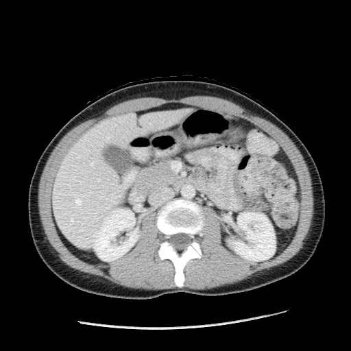 Castleman disease with fibrous pseudotumor in the abdomen (Radiopaedia 77296-89373 A 48).jpg