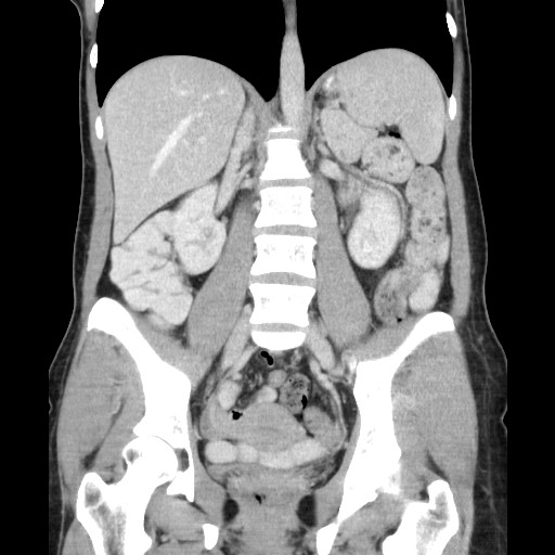 Castleman disease with fibrous pseudotumor in the abdomen (Radiopaedia 77296-89373 B 55).jpg