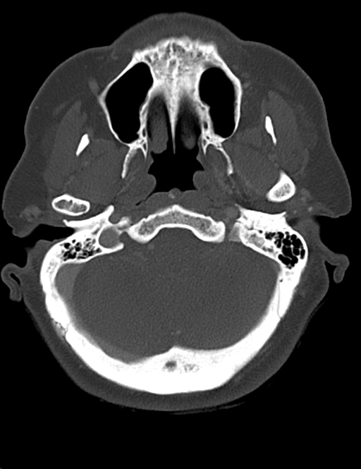 Causes of dysphagia (Radiopaedia 40149-42657 Axial bone window 9).png