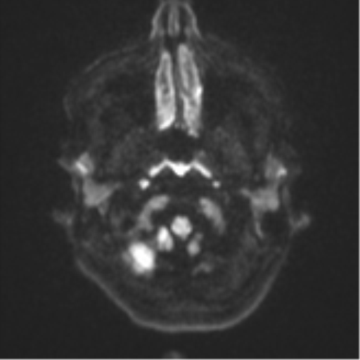 File:Cavernoma with bleed - midbrain (Radiopaedia 54546-60774 Axial DWI 29).png