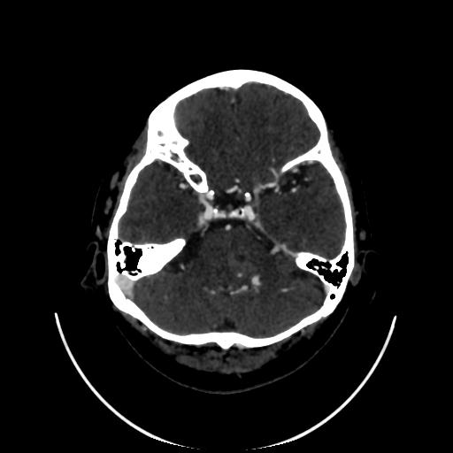 Cavernoma with developmental venous anomaly (Radiopaedia 22470-22506 C 36).jpg