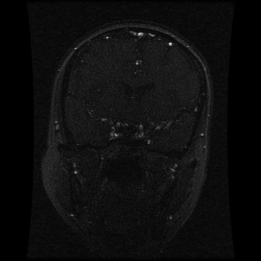 Cavernoma with developmental venous anomaly (Radiopaedia 22470-22507 MRV 84).jpg