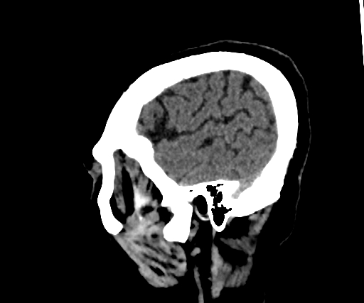Cavernous hemangioma of the cerebellar falx (Radiopaedia 73025-83723 B 277).jpg