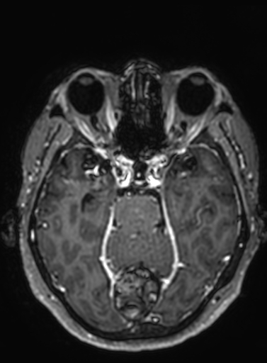 Cavernous hemangioma of the cerebellar falx (Radiopaedia 73025-83724 Axial T1 C+ 218).jpg