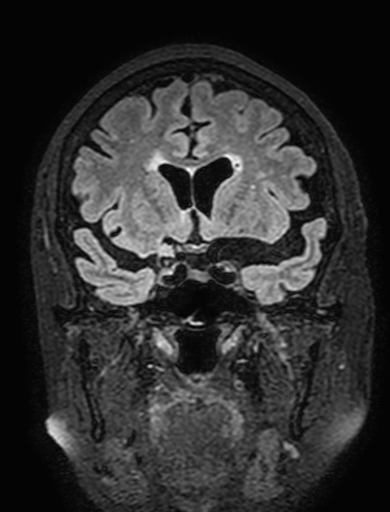 Cavernous hemangioma of the cerebellar falx (Radiopaedia 73025-83724 Coronal FLAIR 126).jpg