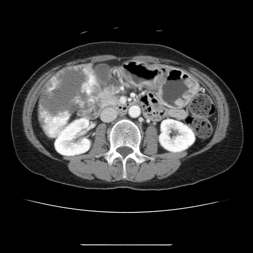 File:Cavernous hepatic hemangioma (Radiopaedia 75441-86667 B 53).jpg