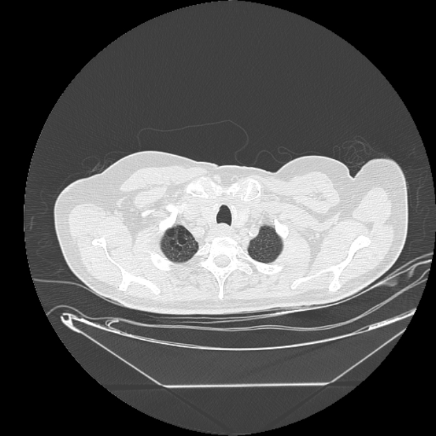 Cavitating bronchogenic carcinoma (Radiopaedia 44489-48162 Axial lung window 3).jpg
