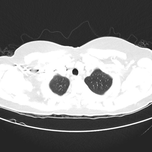 File:Cavitating lung mass - squamous cell carcinoma (Radiopaedia 48047-52854 Axial lung window 7).png