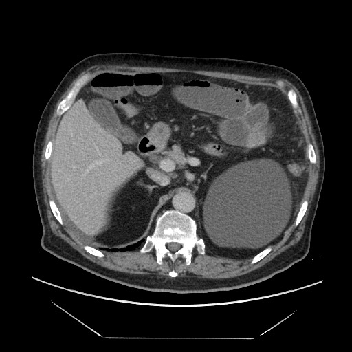 Cecal adenocarcinoma (Radiopaedia 64871-73817 A 24).jpg