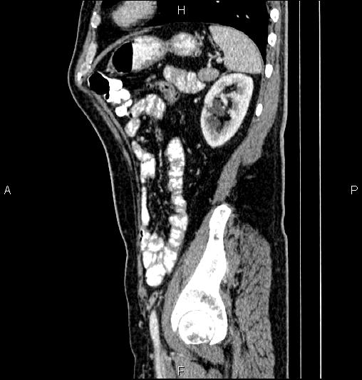 Cecal adenocarcinoma (Radiopaedia 85324-100916 E 71).jpg