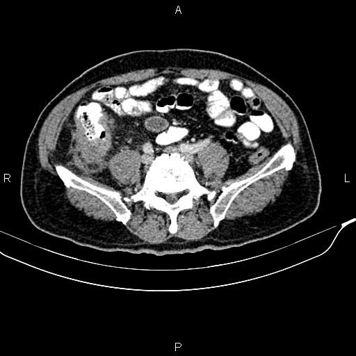 Cecal cancer with appendiceal mucocele (Radiopaedia 91080-108651 B 72).jpg