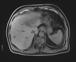 Cecal mass causing appendicitis (Radiopaedia 59207-66532 Axial T1 31).jpg