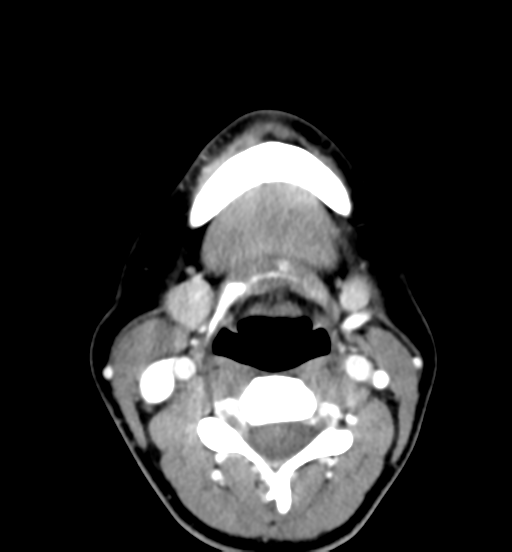 File:Cemento-ossifying fibroma (Radiopaedia 46243-50643 Axial C+ delayed 47).png
