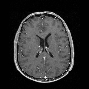Central-variant posterior reversible encephalopathy syndrome (PRES) (Radiopaedia 43880-47358 Axial T1 C+ 100).jpg
