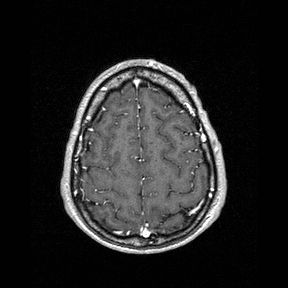 Central-variant posterior reversible encephalopathy syndrome (PRES) (Radiopaedia 43880-47358 Axial T1 C+ 142).jpg