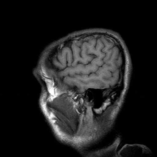 File:Central-variant posterior reversible encephalopathy syndrome (PRES) (Radiopaedia 43880-47359 Sagittal T1 22).jpg