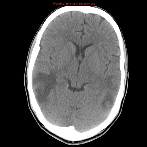 File:Central nervous system vasculitis (Radiopaedia 8410-9234 Axial non-contrast 12).jpg
