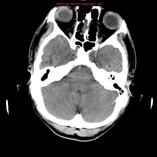 File:Central nervous system vasculitis (Radiopaedia 8410-9234 Axial non-contrast 30).jpg