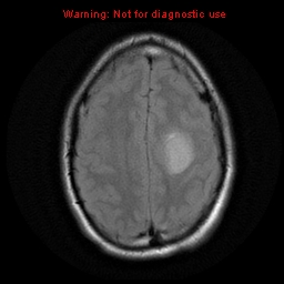 File:Central neurocytoma (Radiopaedia 13188-13206 Axial FLAIR 8).jpg