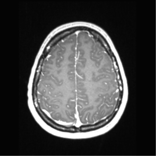 Central neurocytoma (Radiopaedia 37664-39557 Axial T1 C+ 63).png
