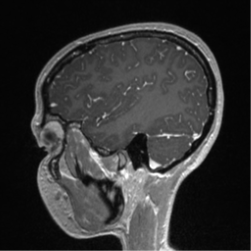 File:Central neurocytoma (Radiopaedia 37664-39557 Sagittal T1 C+ 74).png