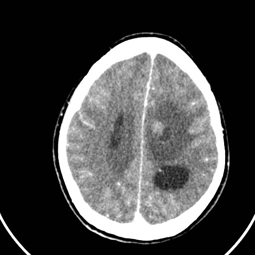 Central neurocytoma (Radiopaedia 84497-99871 B 35).jpg