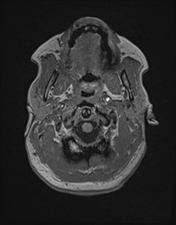 Central neurocytoma (Radiopaedia 84497-99872 Axial T1 24).jpg