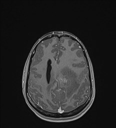 Central neurocytoma (Radiopaedia 84497-99872 Axial T1 C+ 111).jpg