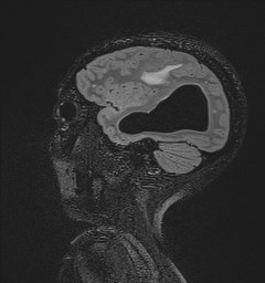File:Central neurocytoma (Radiopaedia 84497-99872 Sagittal Flair + Gd 115).jpg