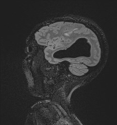 Central neurocytoma (Radiopaedia 84497-99872 Sagittal Flair + Gd 118).jpg