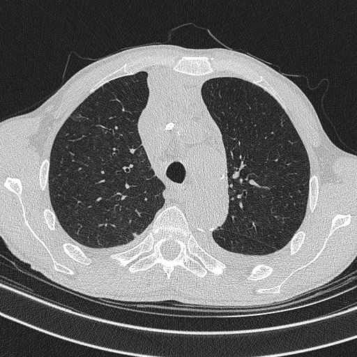 Central venous catheter tip extravasation (Radiopaedia 82828-97113 Axial lung window 28).jpg