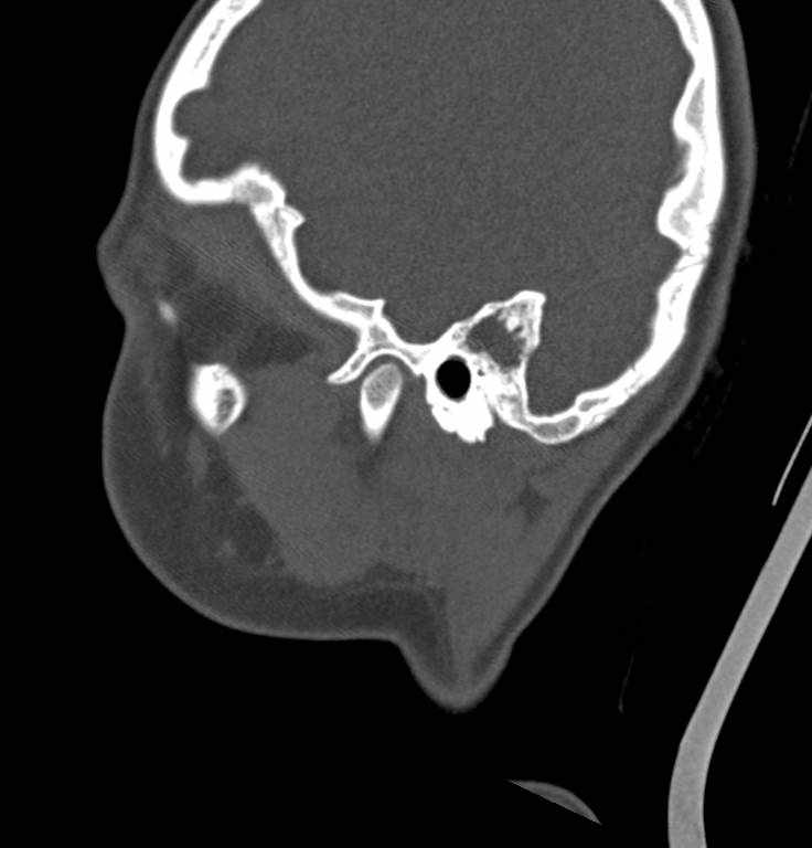 Cerebellar abscess (Radiopaedia 73727-84527 Sagittal bone window 30).jpg
