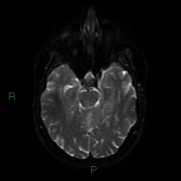 Cerebellar abscess (Radiopaedia 78135-90678 Axial DWI 42).jpg
