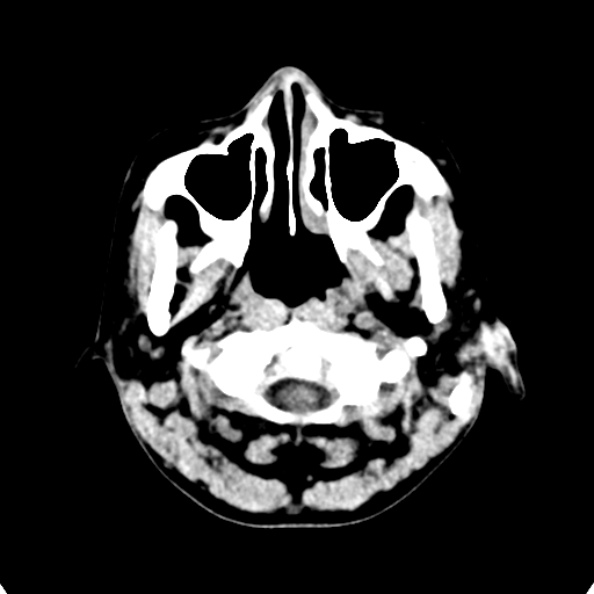 Cerebellar abscess secondary to mastoiditis (Radiopaedia 26284-26412 Axial non-contrast 4).jpg