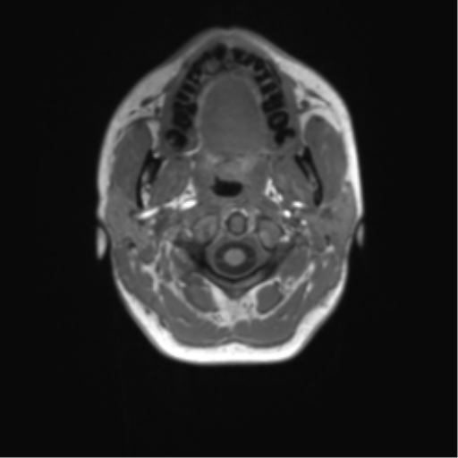 Cerebellar agenesis with hypoplastic pons (pontocerebellar hypoplasia) (Radiopaedia 57224-64138 Axial T1 2).png