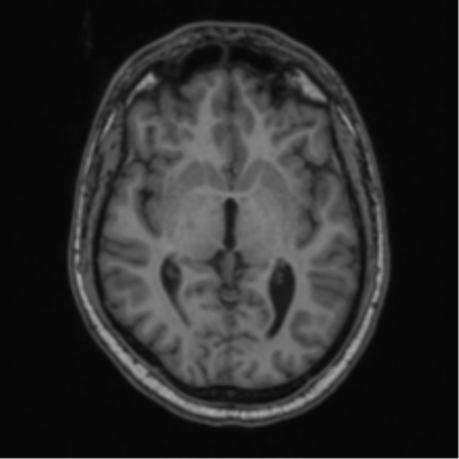 File:Cerebellar hemangioblastomas and pituitary adenoma (Radiopaedia 85490-101176 Axial T1 36).png