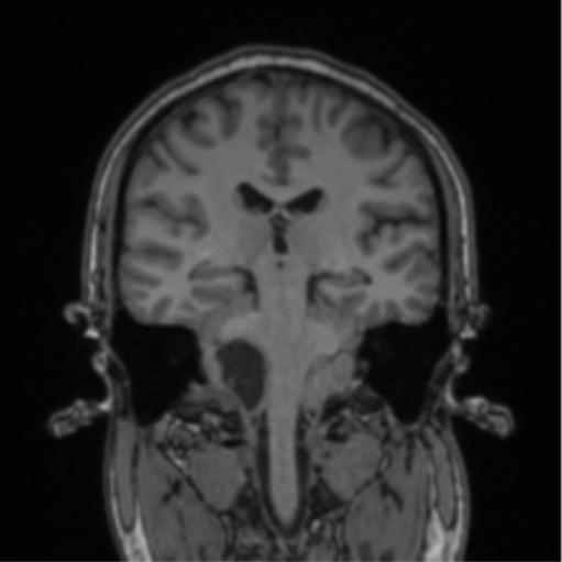 Cerebellar hemangioblastomas and pituitary adenoma (Radiopaedia 85490-101176 Coronal T1 42).png