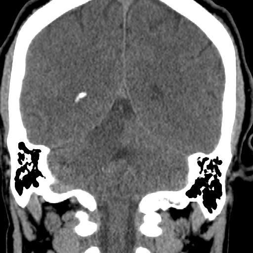 Cerebellar infarction (Radiopaedia 16625-16327 Coronal non-contrast 23).jpg