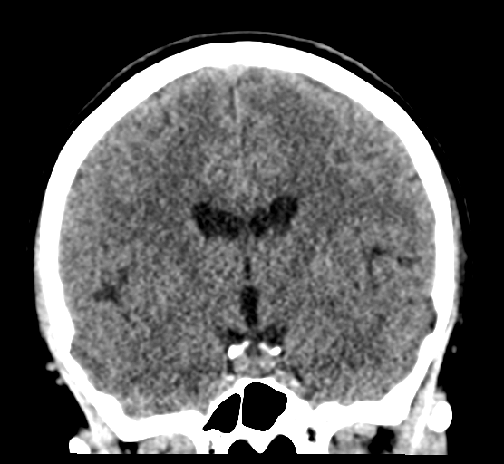 Cerebellar metastases - colorectal adenocarcinoma (Radiopaedia 40947-43652 Coronal non-contrast 47).png