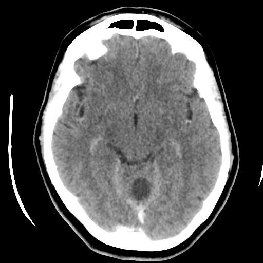 Cerebellar metastasis (cystic appearance) (Radiopaedia 41395-44258 B 22).png